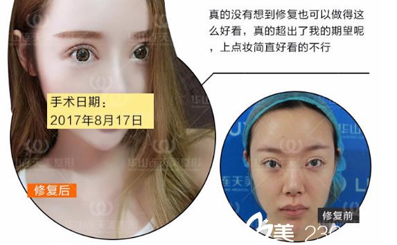 姜鑫利医生的双眼皮修复案例