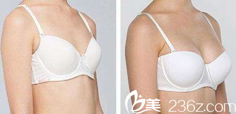 运城丽都整形王新灿隆胸案例展示