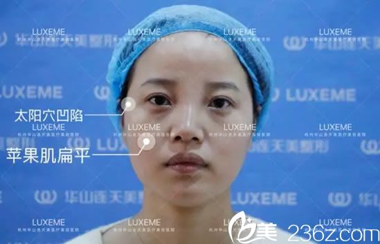 注射玻尿酸和瘦脸前的照片 注射玻尿酸和瘦脸前的照片