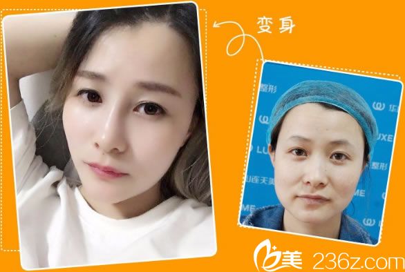 李大琦医生注射瘦脸案例 李大琦医生注射瘦脸案例