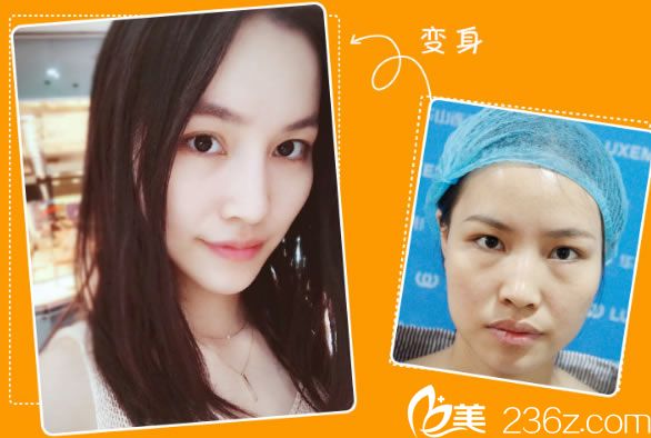 李大琦医生注射玻尿酸的案例 李大琦医生注射玻尿酸的案例