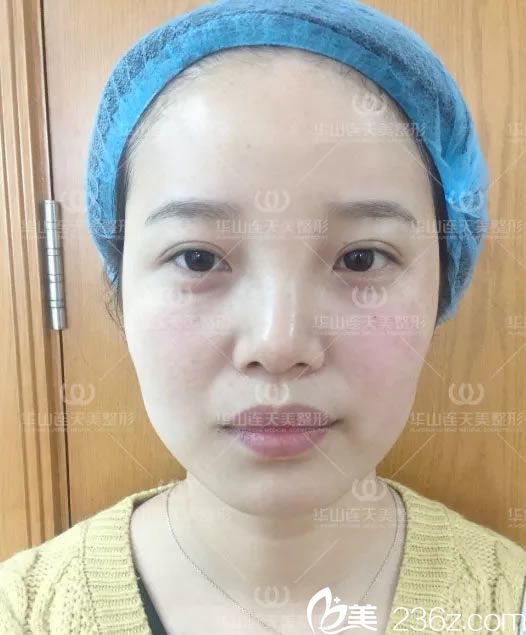 注射玻尿酸即刻效果图 注射玻尿酸即刻效果图