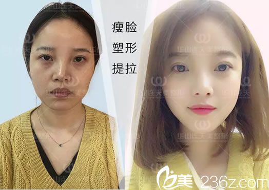 注射瘦脸前后效果对比照 注射瘦脸前后效果对比照