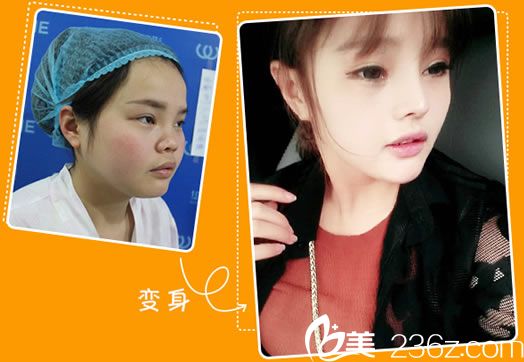 华派美鼻案例效果图