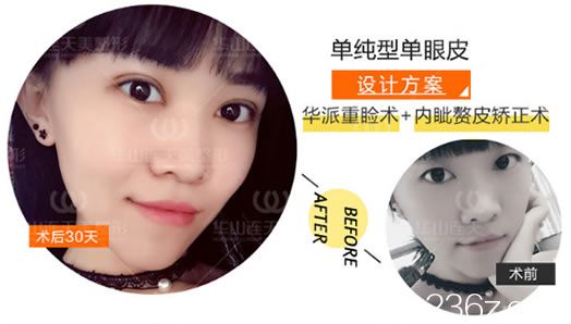 华派美眼术案例效果图