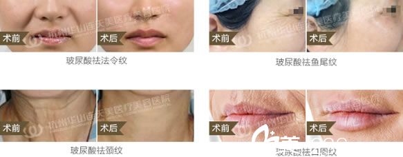 柳春红医生注射玻尿酸除皱效果 柳春红医生注射玻尿酸除皱效果