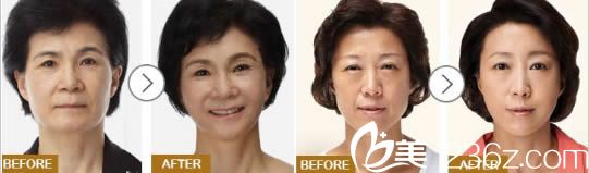 张水金面部除皱前后对比效果图 张水金面部除皱前后对比效果图