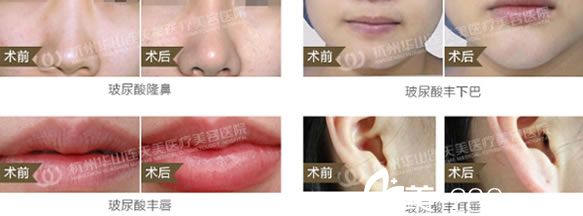 注射玻尿酸塑形案例图 注射玻尿酸塑形案例图