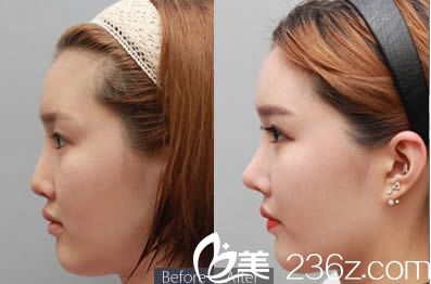 张水金医生隆鼻案例 张水金医生隆鼻案例