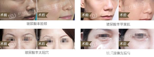 注射玻尿酸填充案例图 注射玻尿酸填充案例图