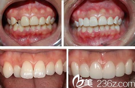 全瓷牙修复的效果图 全瓷牙修复的效果图