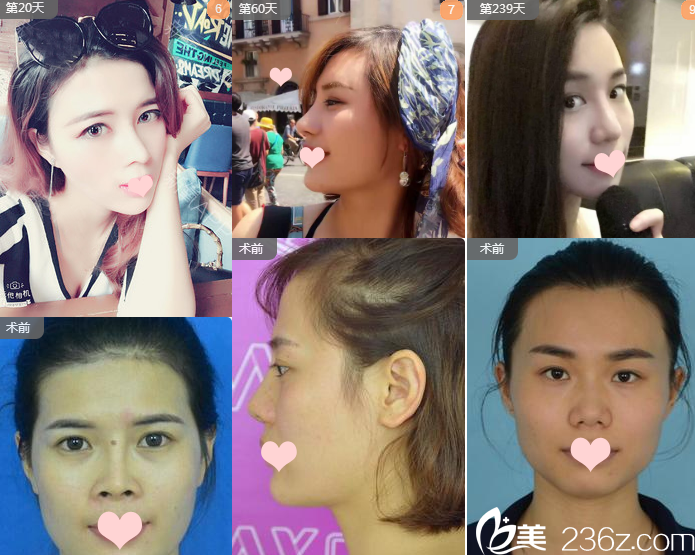 南宁梦想整形医生周维志鼻综合隆鼻案例组图 南宁梦想整形医生周维志鼻综合隆鼻案例组图