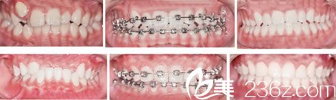 直丝弓矫正牙畸形的效果 直丝弓矫正牙畸形的效果