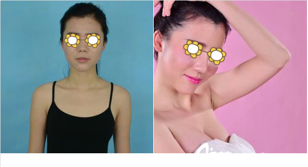 南宁梦想黎洪棉自体脂肪隆胸案例