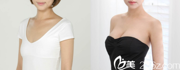 南宁梦想黎洪棉假体隆胸案例