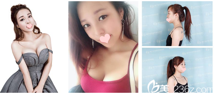 南宁东方整形医院假体隆胸案例 南宁东方整形医院假体隆胸案例