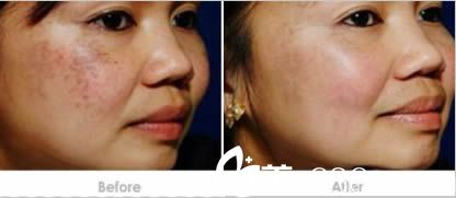 庄婉瑜激光祛斑案例 庄婉瑜激光祛斑案例