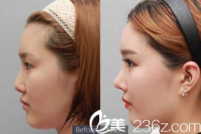 赵正杰隆鼻案例图 赵正杰隆鼻案例图