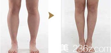 韩国灰姑娘瘦腿瘦腿案例