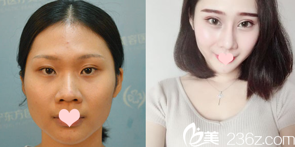 南宁东方整形医院刘刚双眼皮案例 南宁东方整形医院刘刚双眼皮案例