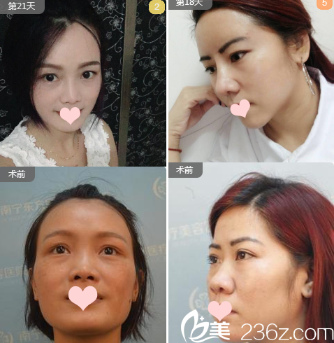 南宁东方刘刚鼻综合案例对比组图 南宁东方刘刚鼻综合案例对比组图