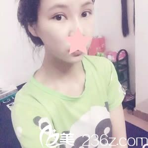 盛宗顺做眼睛术后15天恢复效果 盛宗顺做眼睛术后15天恢复效果