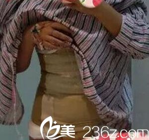 我在沈阳茗湲做腰腹吸脂手术后2天.jpg