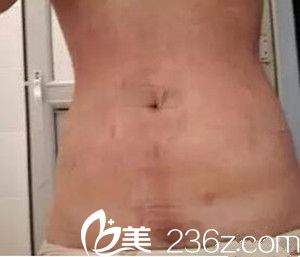 我在沈阳茗湲做腰腹吸脂手术后9天.jpg