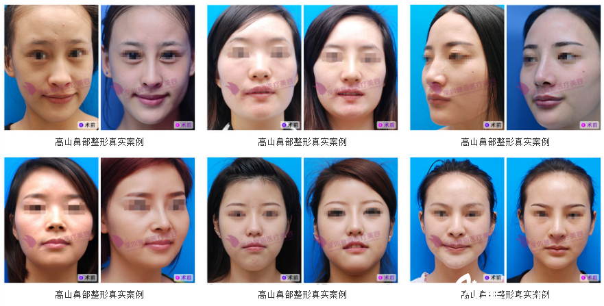深圳隆鼻医生高山做鼻子案 例图 深圳隆鼻医生高山做鼻子案 例图