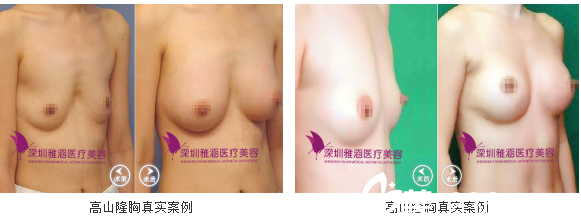 深圳雅涵医疗美容高山隆胸<span style= 深圳雅涵医疗美容高山隆胸<span style=