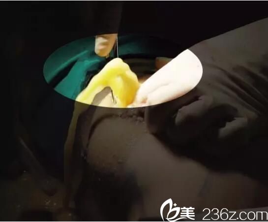 提醒2性填充物，慎选 韩楚