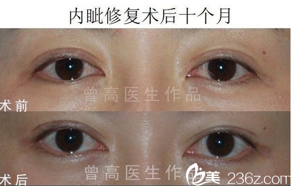 广州华美曾高做的双眼皮失败修复案例