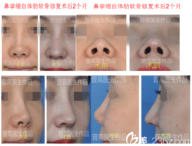 广州华美曾高做的隆鼻案例图片