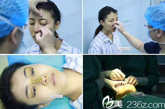 四川美莱韩国栋双眼皮隆鼻手术设计