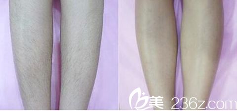 驻马店美兰德脱腿毛案例 驻马店美兰德脱腿毛案例