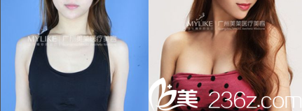 广州美莱<!--<i data=20240703-sp></i>-->隆胸<span style=