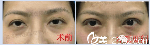 广州美莱黄泽春双眼皮失败修复<span style=