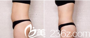 广州美莱王志军吸脂<span style=