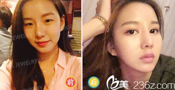 柳然植院长的双眼皮案例 柳然植院长的双眼皮案例