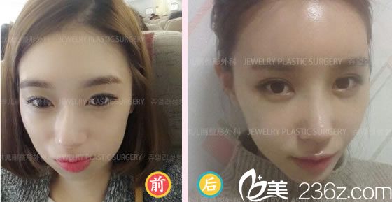 柳然植院长鼻修复案例 柳然植院长鼻修复案例