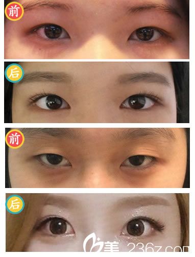 赵庸真院长的眼部整形案例 赵庸真院长的眼部整形案例