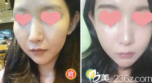 申奇澈院长的轮廓整形案例 申奇澈院长的轮廓整形案例