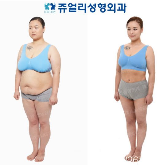 全寅成院长的肥胖管理案例 全寅成院长的肥胖管理案例