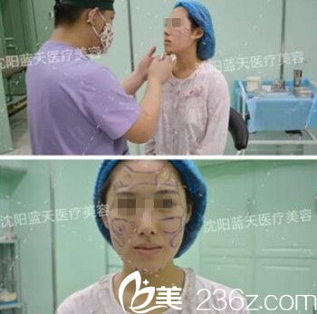在沈阳蓝天做面部脂肪填充手术设计.jpg 在沈阳蓝天做面部脂肪填充手术设计.jpg