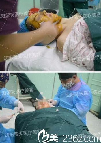 在沈阳蓝天做面部脂肪填充手术中.jpg 在沈阳蓝天做面部脂肪填充手术中.jpg