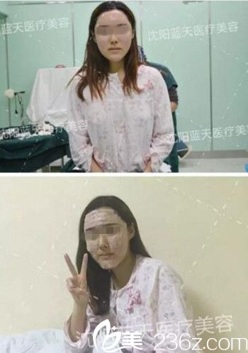 在沈阳蓝天做面部脂肪填充手术当天.jpg 在沈阳蓝天做面部脂肪填充手术当天.jpg