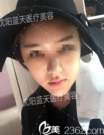 在沈阳蓝天做面部脂肪填充术后3天.jpg 在沈阳蓝天做面部脂肪填充术后3天.jpg