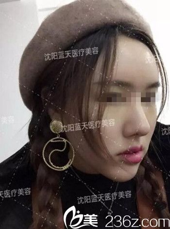 在沈阳蓝天做面部脂肪填充术后半个月.jpg 在沈阳蓝天做面部脂肪填充术后半个月.jpg