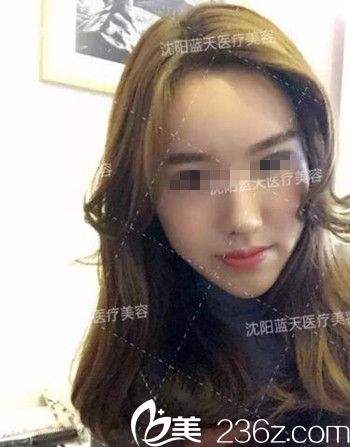 在沈阳蓝天做面部脂肪填充术后45天.jpg 在沈阳蓝天做面部脂肪填充术后45天.jpg