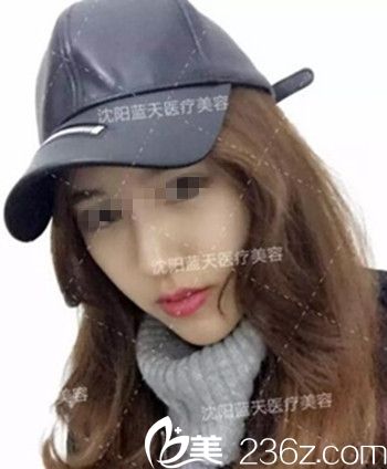 在沈阳蓝天做面部脂肪填充术后2个月.jpg 在沈阳蓝天做面部脂肪填充术后2个月.jpg